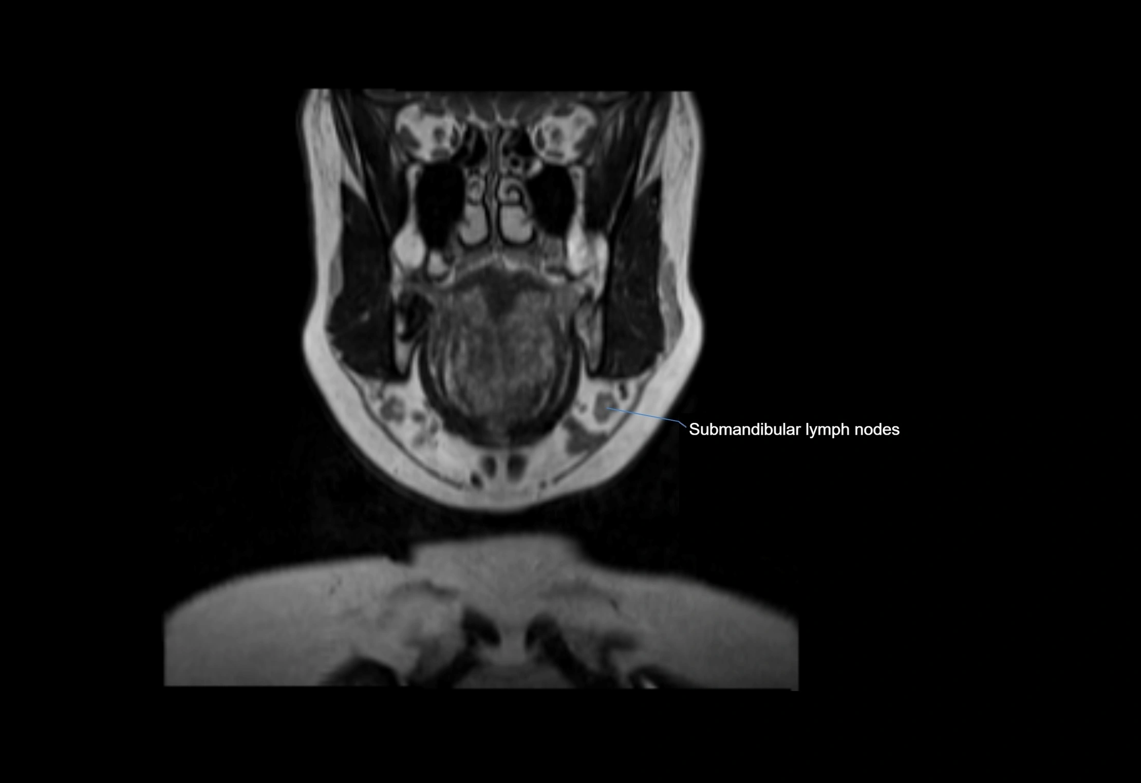 Neck coronal lymph node cross sectional MRI anatomy 3T MRI  image-img-00001-00054.webp